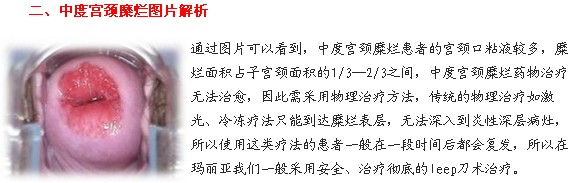 宫颈糜烂图片是什么样 杨陵妇科给你介绍